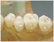 All-Ceramic